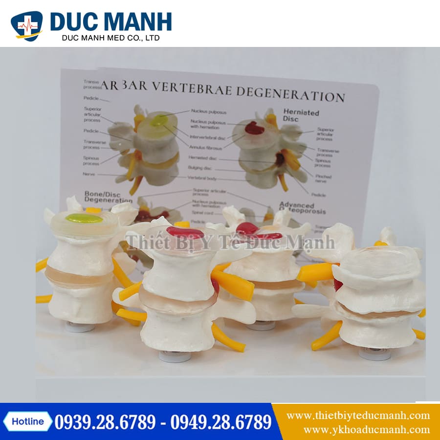 Mô hình đốt sống bình thường và bệnh lý 2 Mo hinh dot song binh thuong va benh ly1