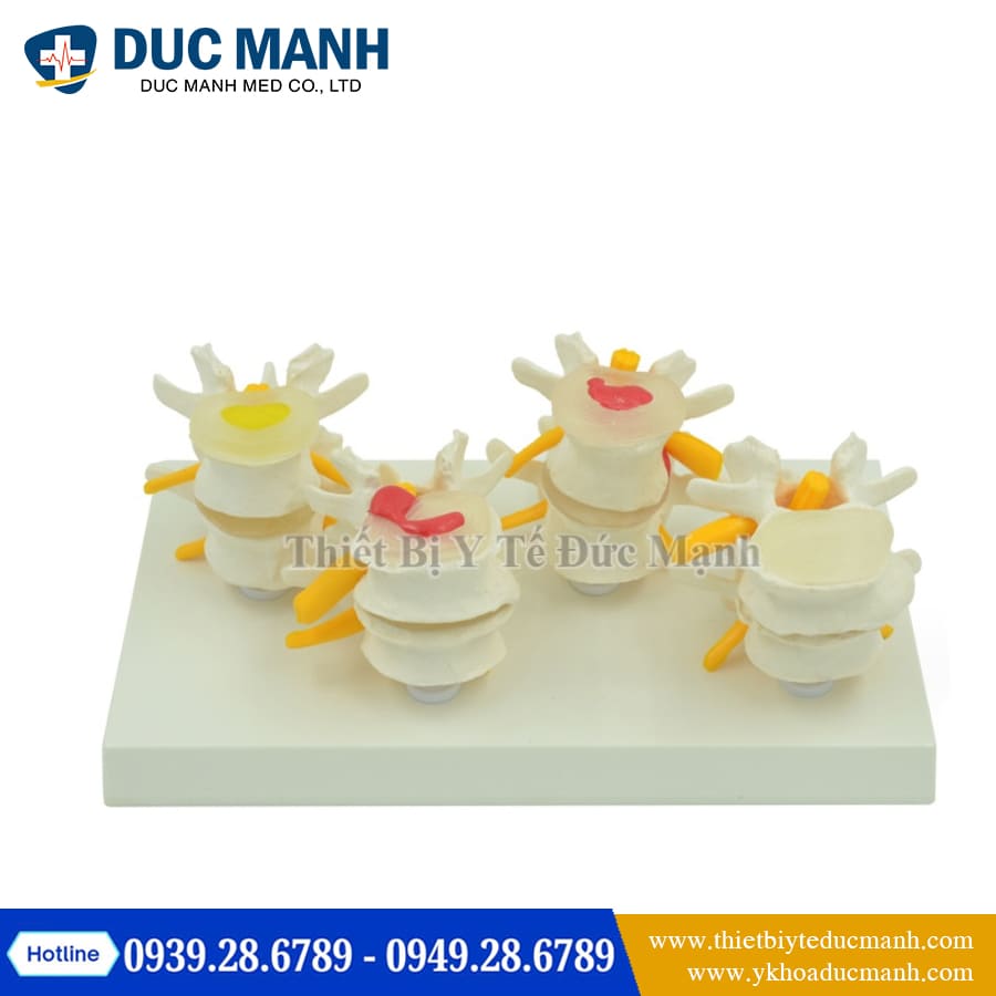 Mô hình đốt sống bình thường và bệnh lý 4 Mo hinh dot song binh thuong va benh ly3