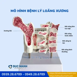 Mô hình bệnh lý loãng xương