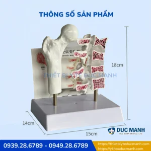 mo hinh benh ly loang xuong 3