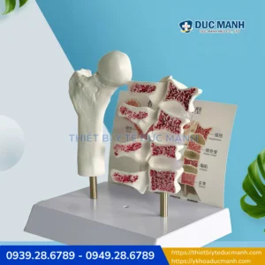 Mô hình bệnh lý loãng xương