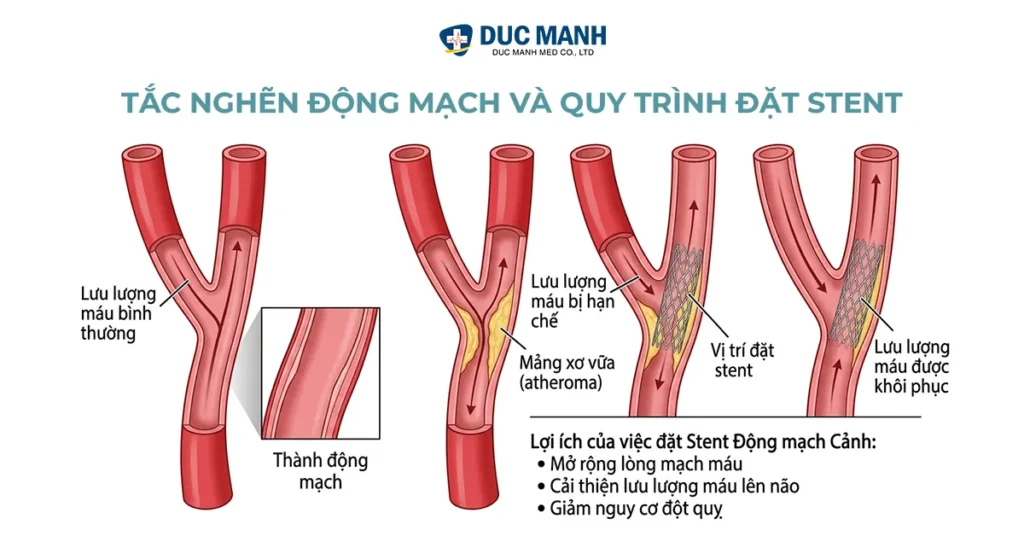 dau hieu tac nghen mach mau trieu chung 1