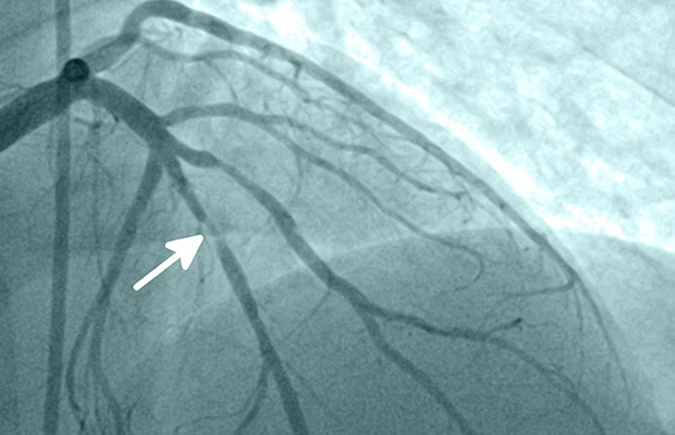 Dấu hiệu tắc nghẽn mạch máu: Triệu chứng, nguyên nhân và cách điều trị