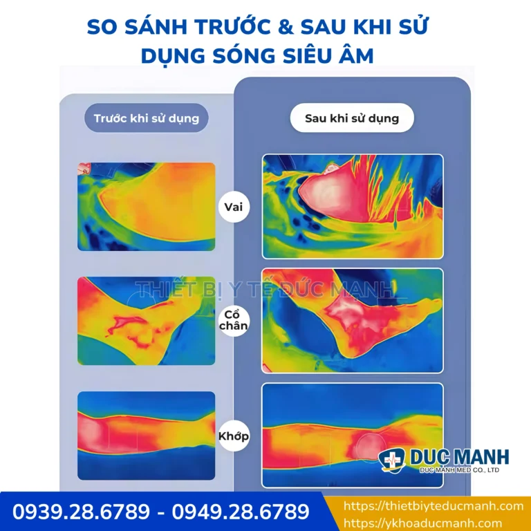 review cac dong may sieu am tri lieu